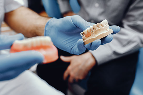 Implantes o puentes dentales: ¿qué opción elegir?