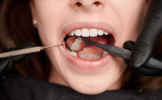 Cómo prevenir las caries en adultos: Consejos para una sonrisa saludable