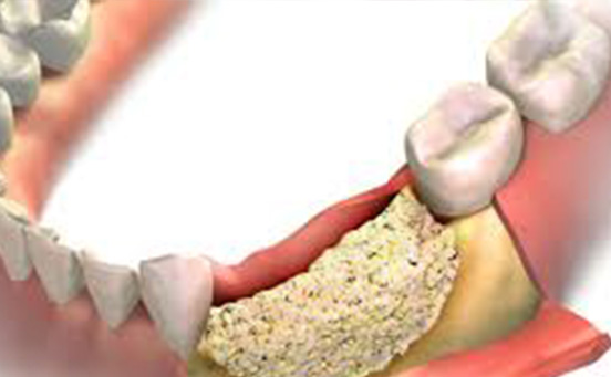 La Regeneración Ósea en Implantología Dental: Todo lo que Necesitas Saber