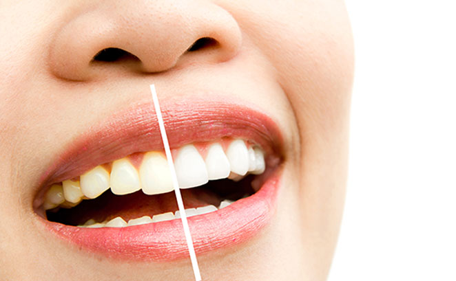 Blanqueamiento dental profesional: ¿Por qué es la mejor opción para una sonrisa radiante?